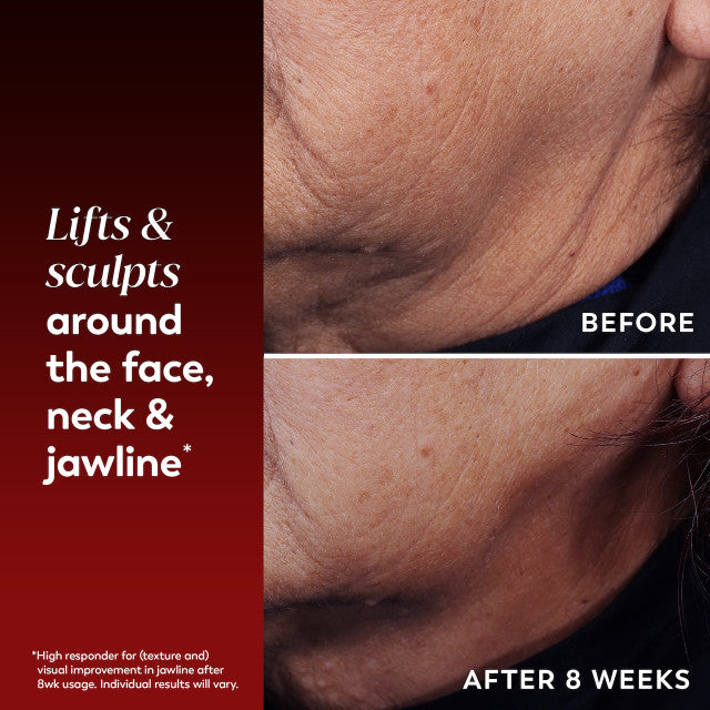 Regenerist Face & Neck Lifting Treatment